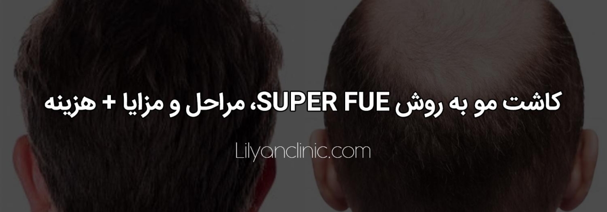 کاشت مو به روش SUPER FUE، مراحل و مزایا+ هزینه